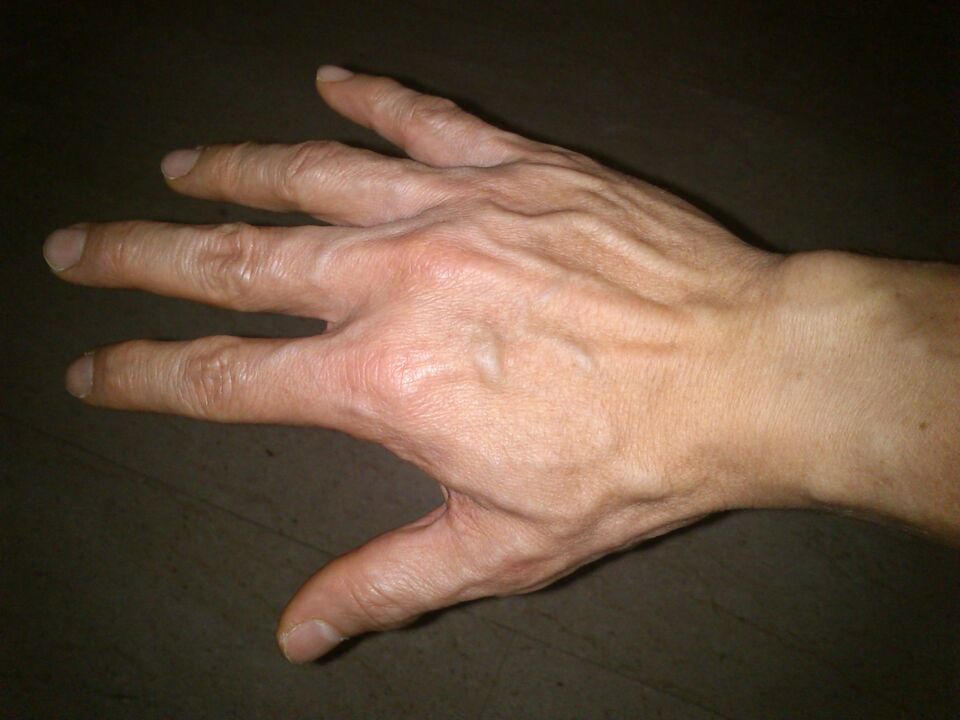 дэфармацыя касцей і болі ў суставах пальцаў рук